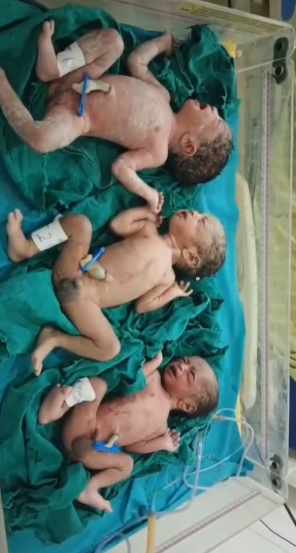 Rare triplet birth reported at BRIMS hospital Bidar