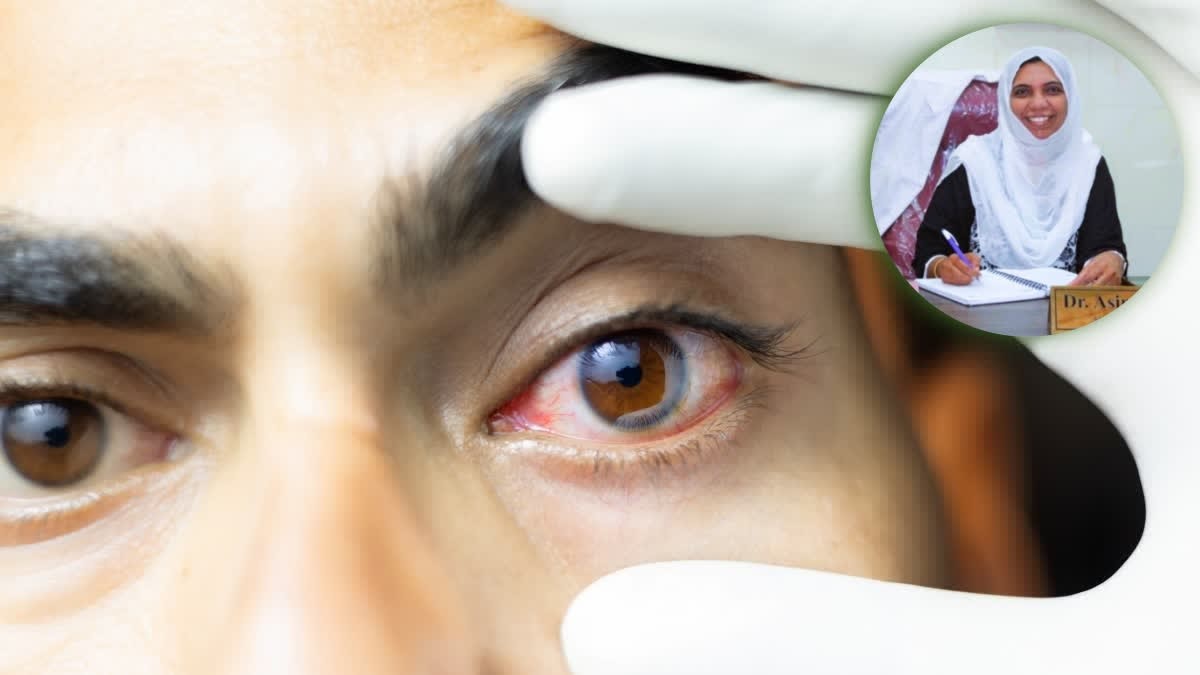 Madras Eye Cases Rise, Doctors Urge School Caution
