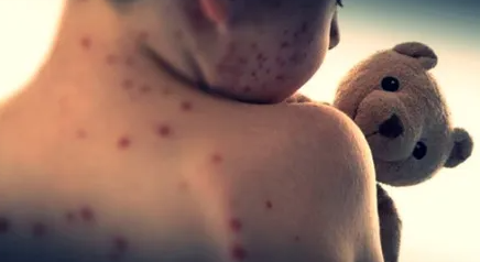 Measles Alert Issued in Northern Sydney, NSW
